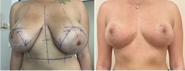 Photo avant/après plastie mammaire