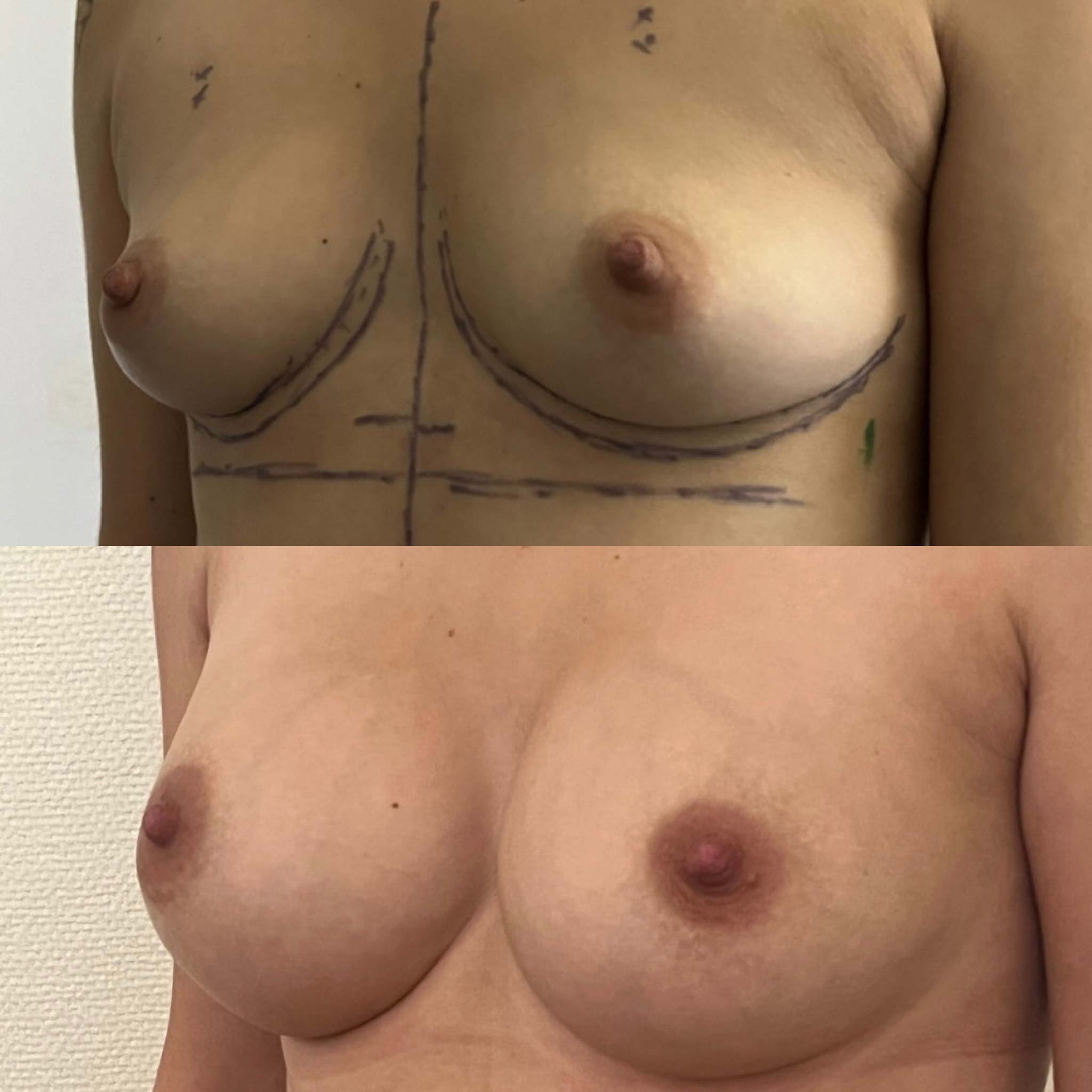 Augmentation mammaire par implants anatomiques rétro-musculaires : Photos avant/après sans cicatrice visible