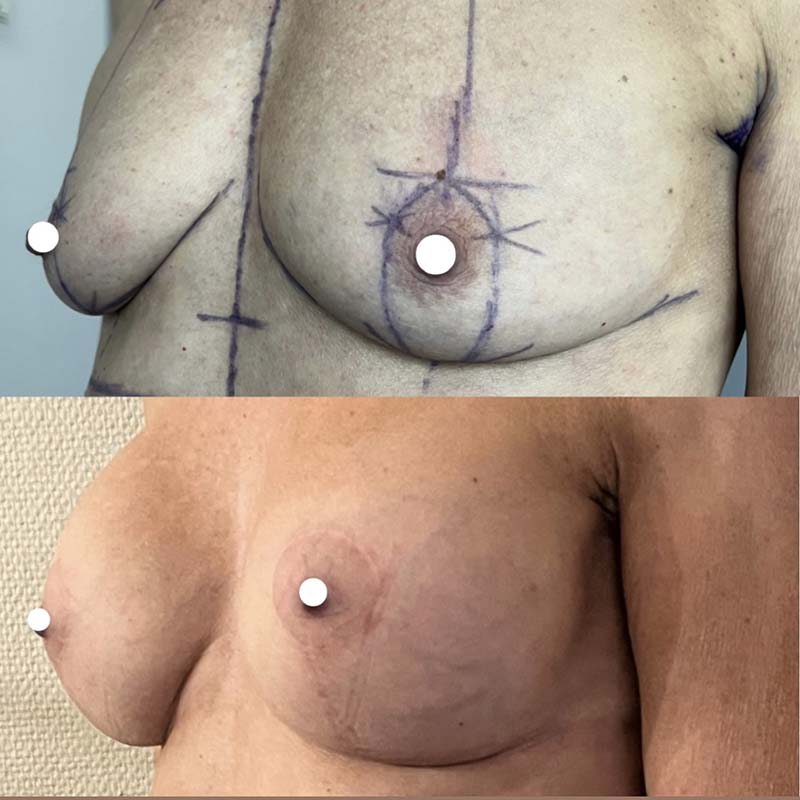 Lifting des seins avec pose d´implants mammaires pour ptose avec hypotrophie