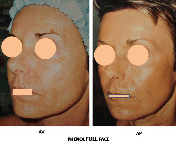 Résultats post-opératoires Peeling du visage
