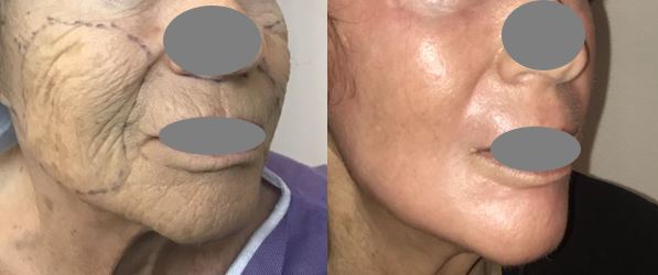 Résultats post-opératoires Peeling du visage