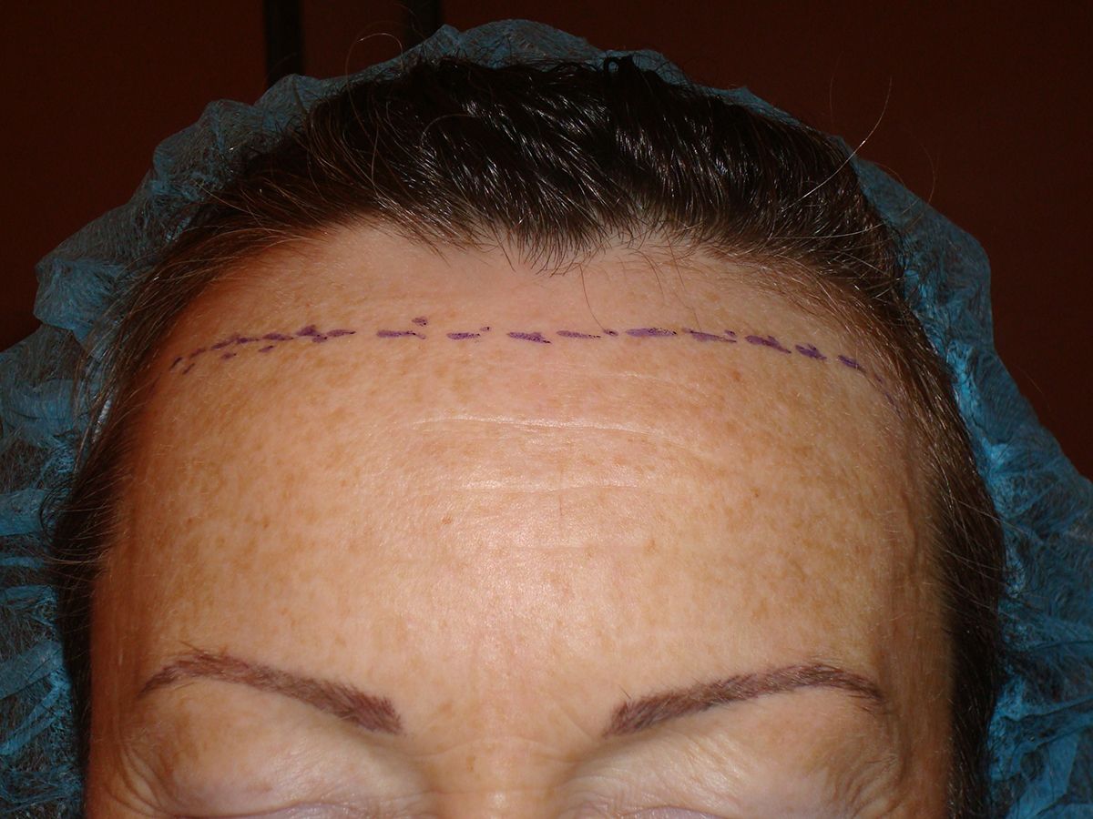Résultats post-opératoires Microgreffe de cheveux contre la calvitie