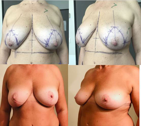 Résultats post-opératoires Plastie mammaire, Lifting des seins