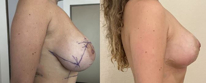 Résultats post-opératoires Réduction mammaire