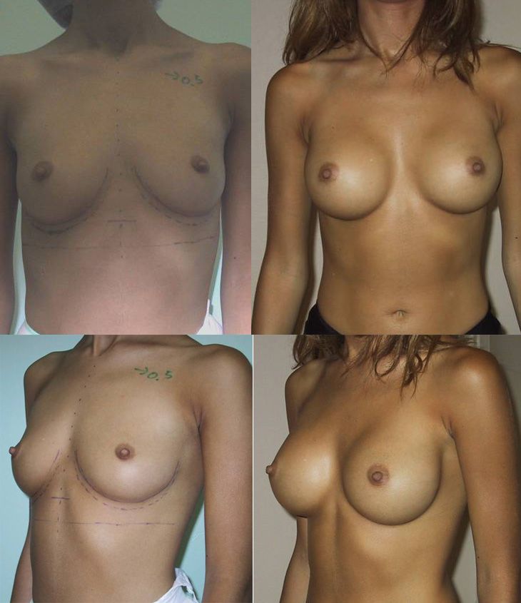 Résultats post-opératoires Chirurgie des seins