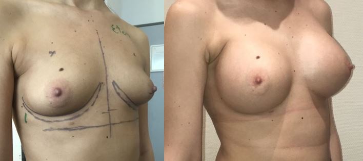 Résultats post-opératoires Implant et prothèse mammaire