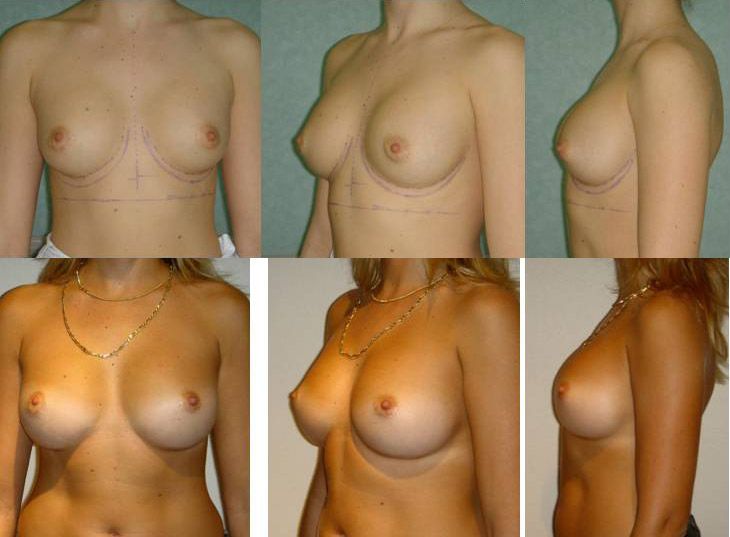 Résultats post-opératoires Chirurgie des seins