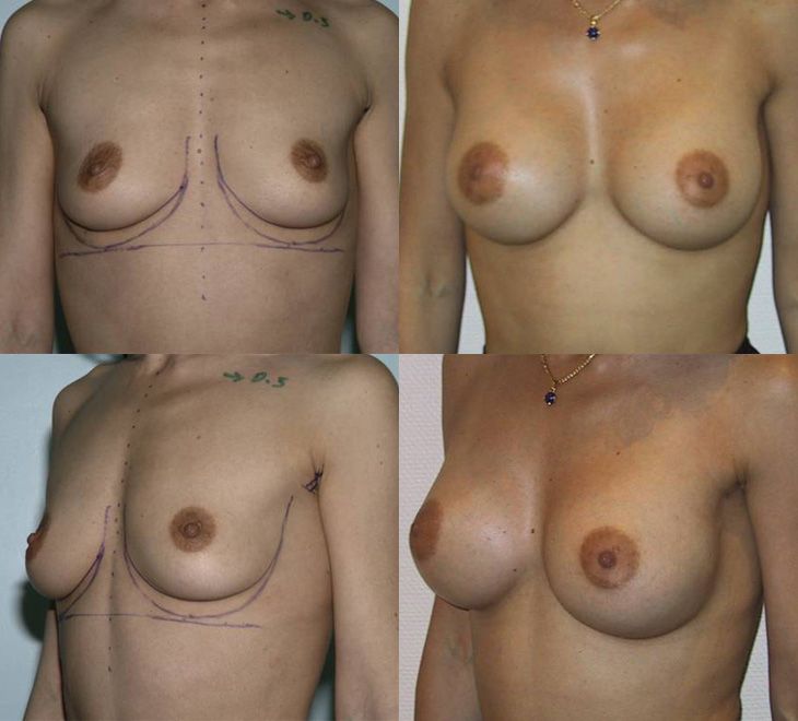 Résultats post-opératoires La voie axillaire pour une augmentation mammaire