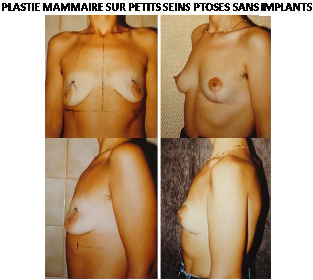 Résultats post-opératoires Plastie mammaire, Lifting des seins
