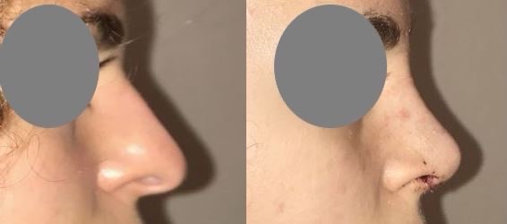 Résultats post-opératoires Rhinoplastie : chirurgie du nez