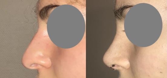 Résultats post-opératoires Rhinoplastie : chirurgie du nez