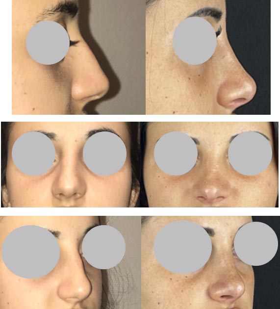 Un nez à votre image : Découvrez la rhinoplastie esthétique