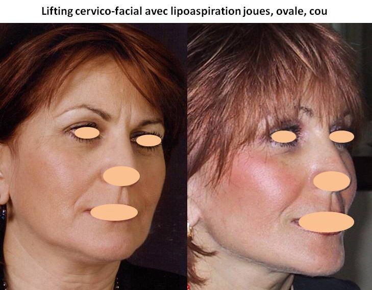 Résultats post-opératoires Lifting du visage