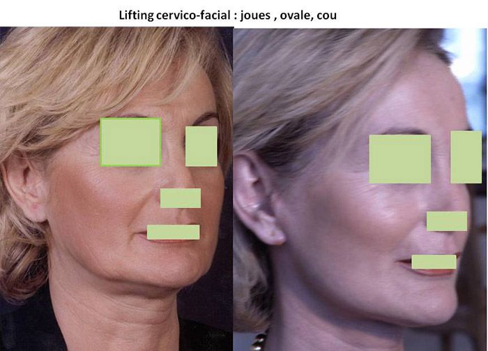 Résultats post-opératoires Lifting du visage