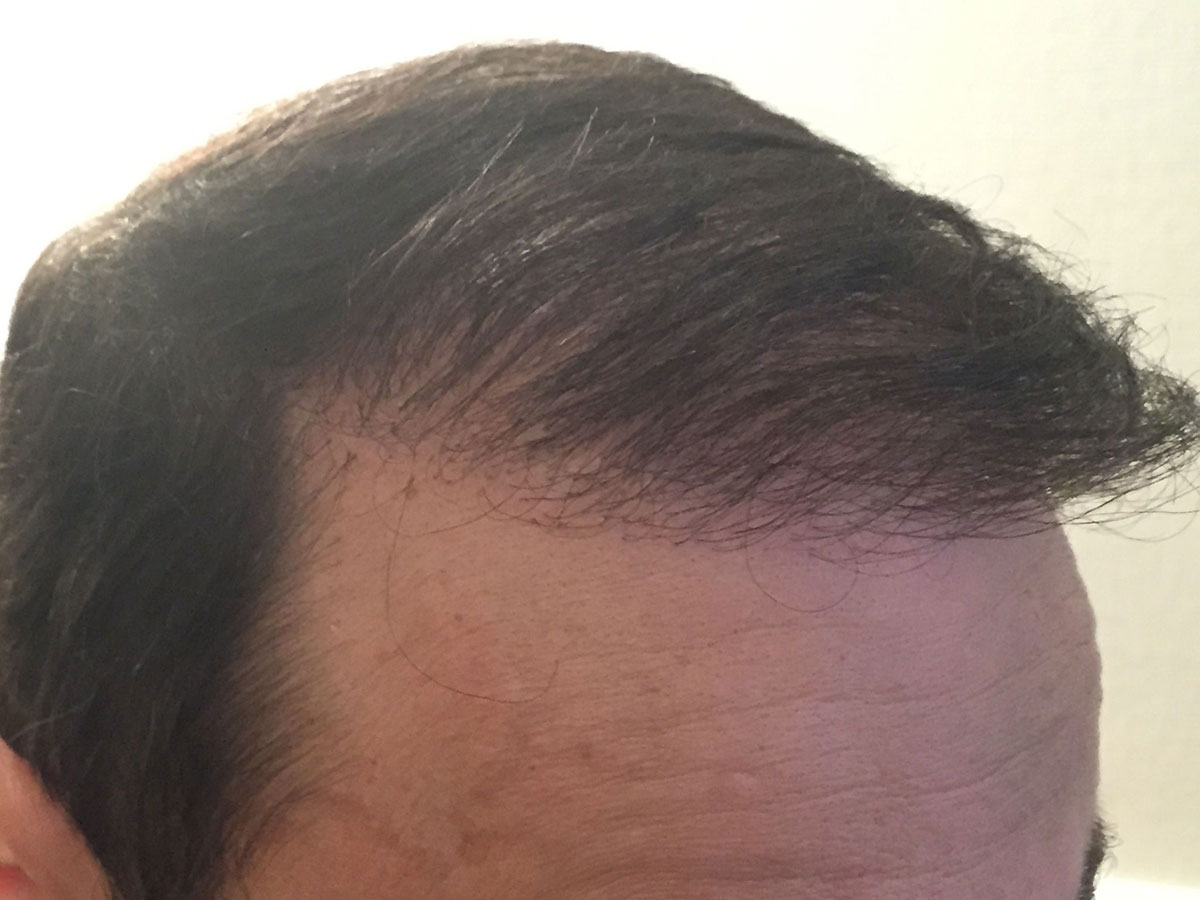 Résultats post-opératoires Greffe de cheveux