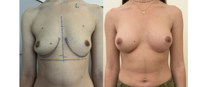 Chirurgie mammaire : implants, prothèses, lifting des seins, lipofilling mammaire 