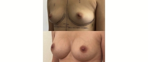 Chirurgie mammaire : implants, prothèses, lifting des seins, lipofilling mammaire 