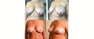 Chirurgie mammaire