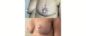 Chirurgie mammaire : implants, lifting des seins, lipofilling mammaire 