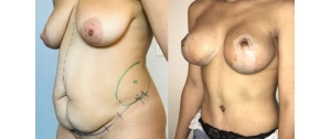 Chirurgie mammaire : implants, lifting des seins, lipofilling mammaire 