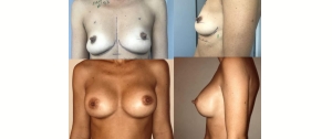 Chirurgie mammaire