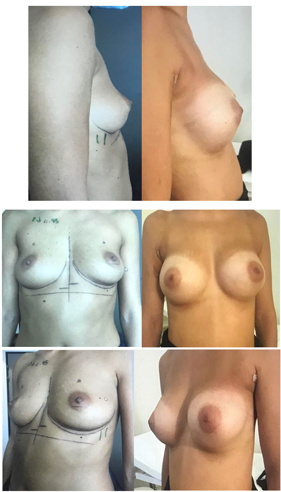 implants anatomiques par voie axillaire sans cicatrice sur les seins