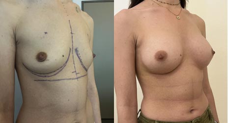 Implants mammaires anatomiques rétro-musculaires sans cicatrices sur les seins