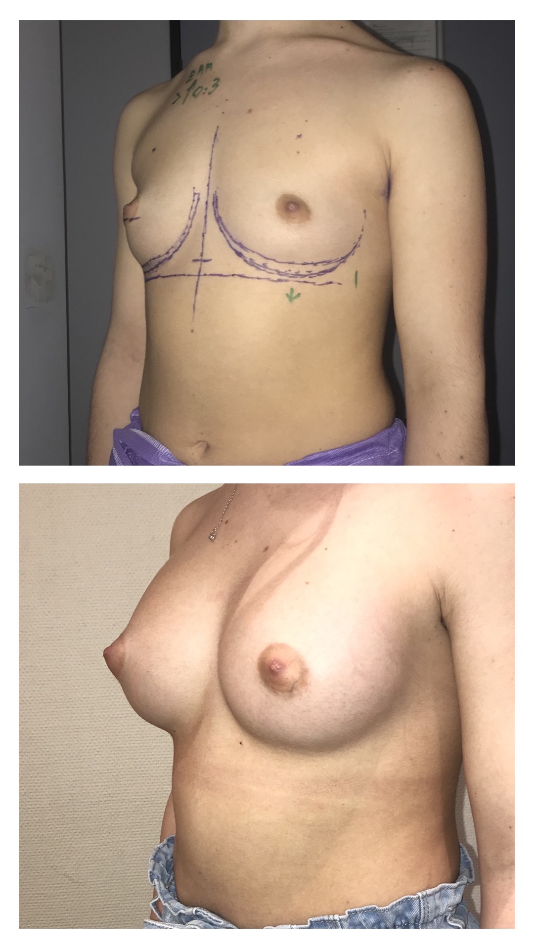 Implants mammaires anatomiques par voie axillaire rétro musculaire sans cicatrice sur les seins