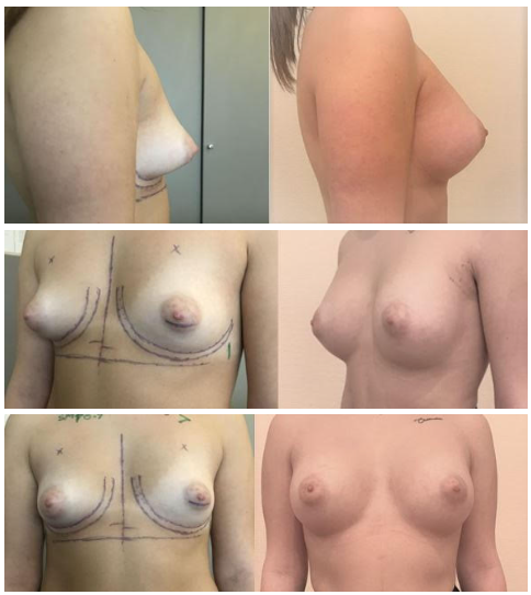 Implants mammaires réto musculaire sans cicatrice sur les seins