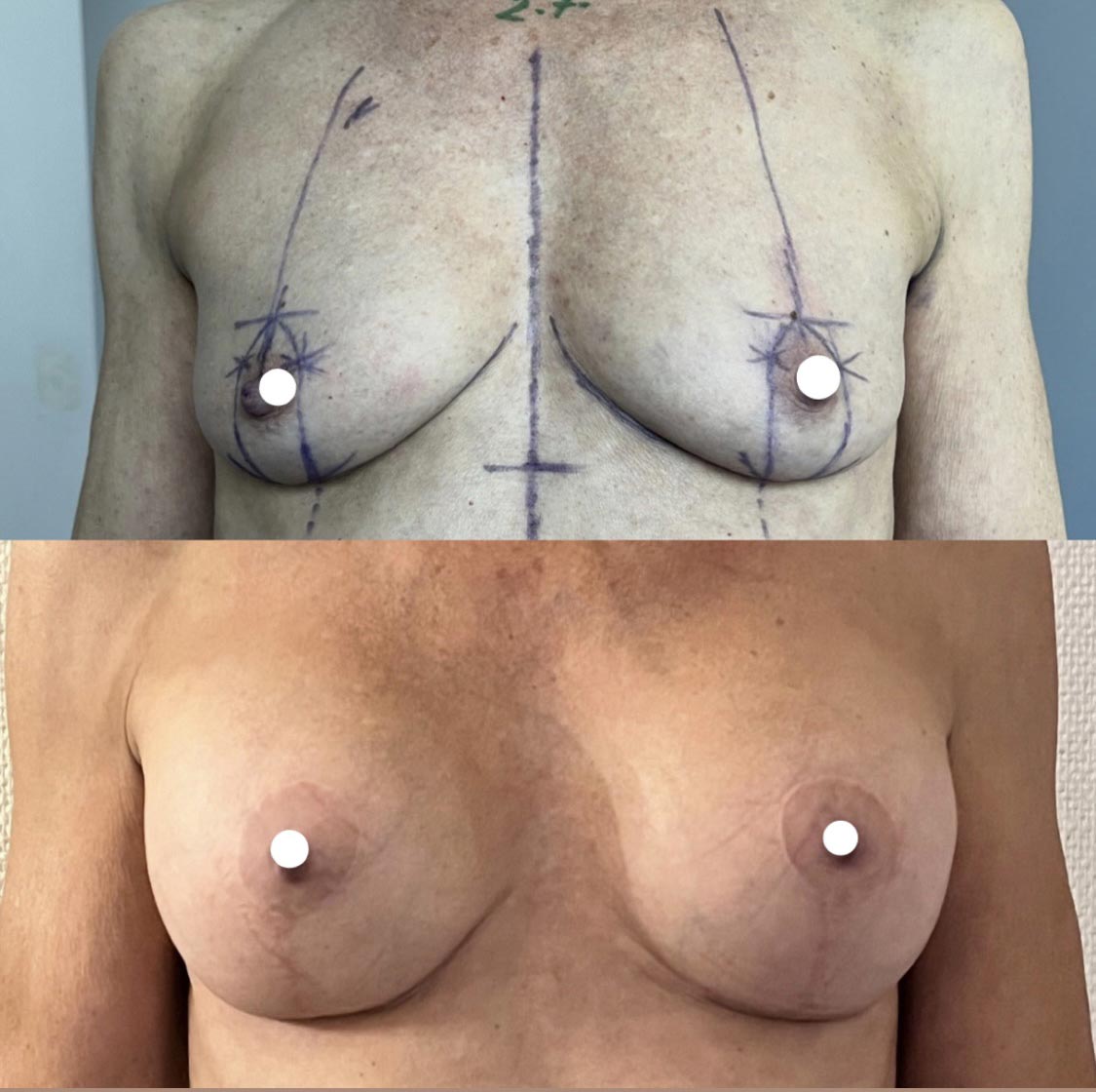Lifting des seins avec pose d'implants mammaires pour ptose avec hypotrophie