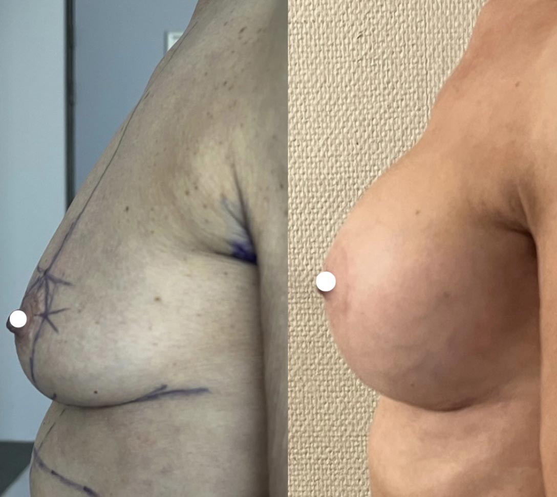 Lifting des seins avec pose d'implants mammaires pour ptose avec hypotrophie