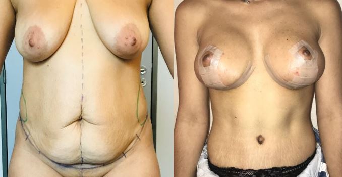 Plastie abdominale et plastie mammaire 2 mois après l'intervention dr marinetti avril 2021