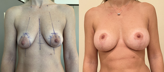 Plastie mammaire et implants mammaires sans cicatrice sur les seins
