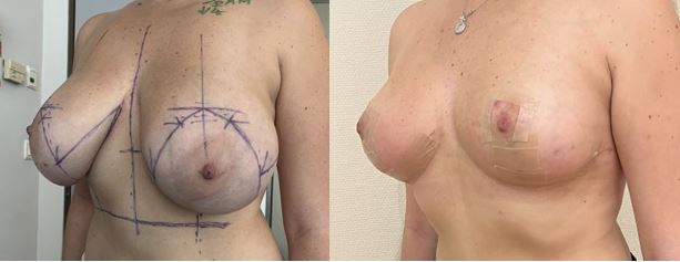 Résultat 3 mois Plastie mammaire avec réduction de volume de 800 g 