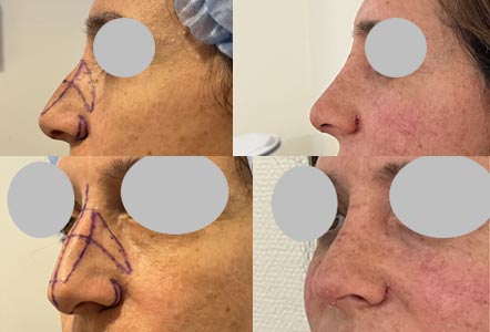 rhinoplastie : résultats post opération 10 jours attelle du nez retirée