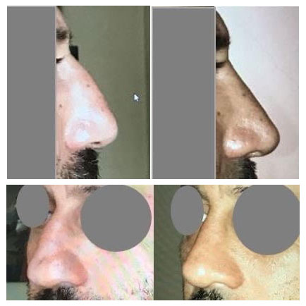 rhinoplastie marseille du Dr Marinetti : photos avant apres
